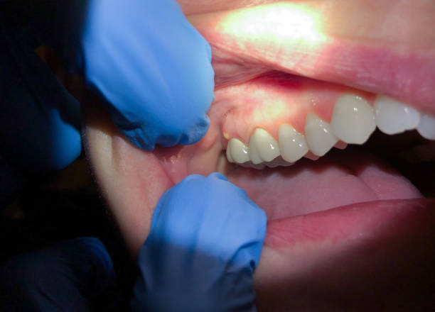 Best Emergency Dental Care for Broken or Chipped Teeth in Sam Rayburn, TX